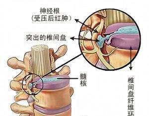 冬季腰腿開筋操緩解腿部麻木疼痛腰間盤突出康復鍛鍊