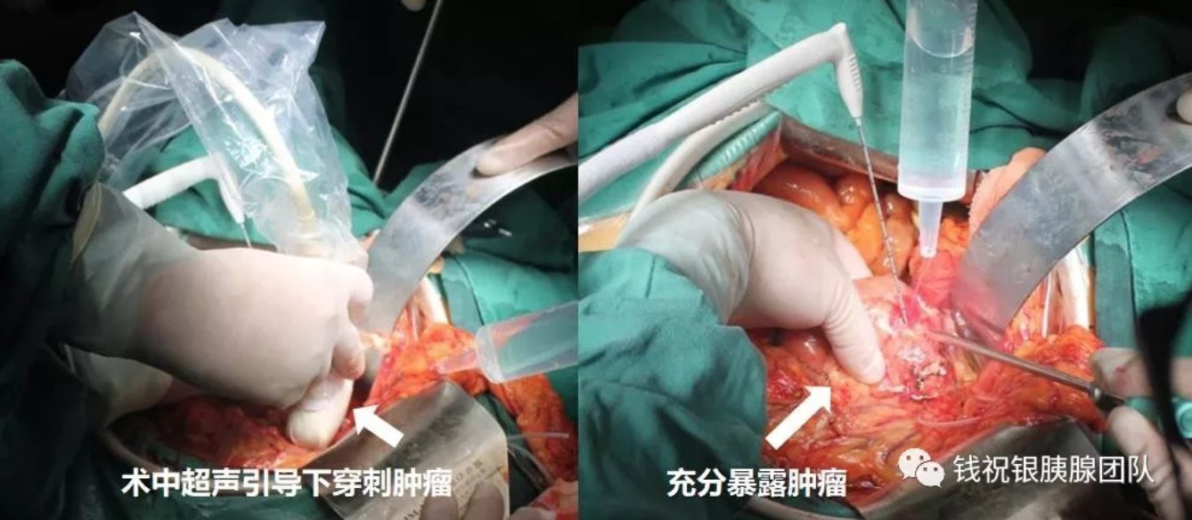 南医大二附院胰腺中心成功开展腹腔镜下胰腺癌冷冻消融术