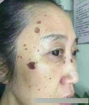 长出"老年斑"不用慌张,教你一个土法子,抹5次色斑一扫而光_凤凰网时尚