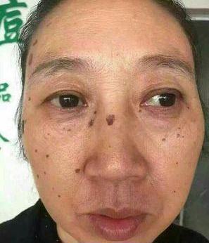 长出"老年斑"千万别慌张,用了这个小方法,斑不见了脸还白了_凤凰网