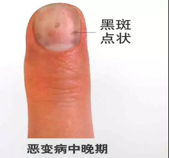 哪种指甲是癌症 全图图片