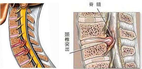 脊髓型颈椎病是由于椎间盘突出,椎体后缘骨刺,黄韧带肥厚或钙化,椎管