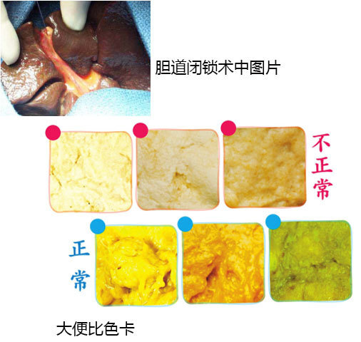 【三分钟营养】第三十七期·暗示肝胆疾病的灰白色陶土便__凤凰网