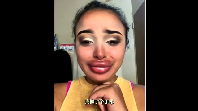 外国一妹子的丰唇手术失败了