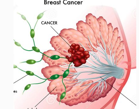 年輕女生患上最嚴重的乳腺癌這種致命殺手主要攻擊年輕人