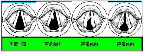 声带正常图片