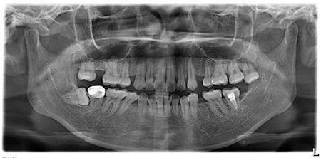 牙曲面断层片图片