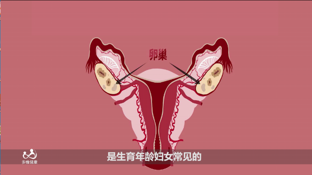 多缘国际什么是多囊卵巢综合征真的有那么严重吗