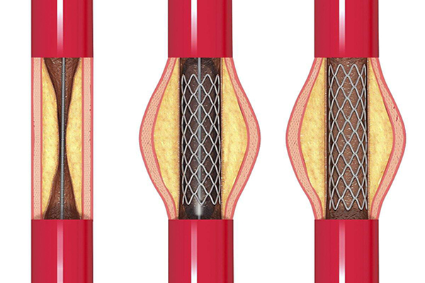 进口血管支架图片
