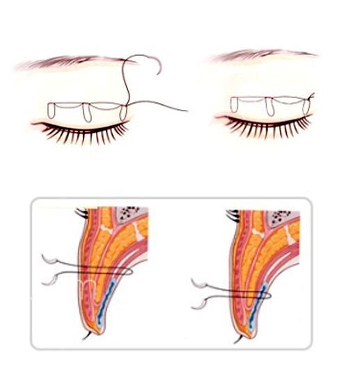 埋线双眼皮不想要了,是不是拆了就可以恢复单眼皮?