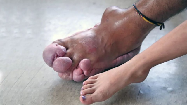 奇闻美国男子换上罕见奇病双脚竟变形成肉球