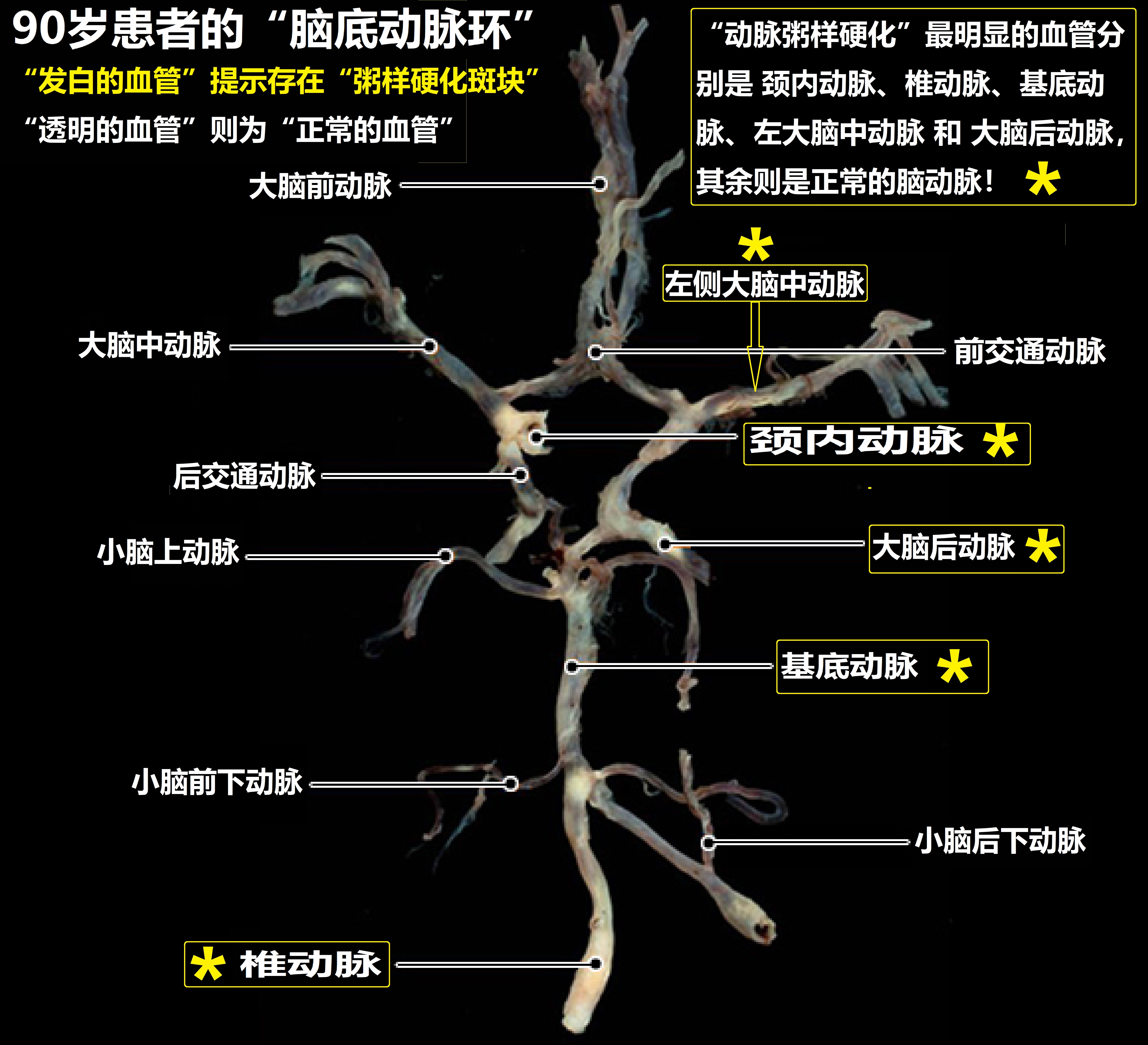 魏社鹏版医学百科——颅内"大动脉粥样硬化"__凤凰网