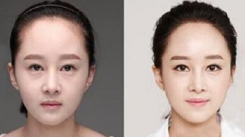 发际线植发和纹发际线有什么区别呢?_凤凰网健康_凤凰网