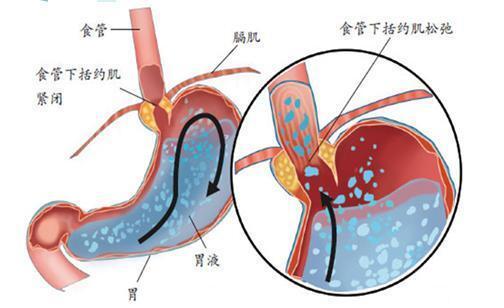 新生儿的"呛奶急救口诀",家长一定要牢记于心
