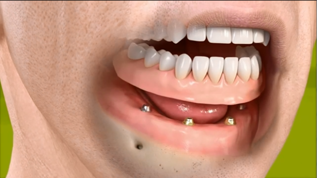 半口种植牙多少钱费用多少贵在哪