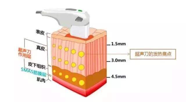 超声刀提升的原理和作用?超声刀后的注意事项?__凤凰网