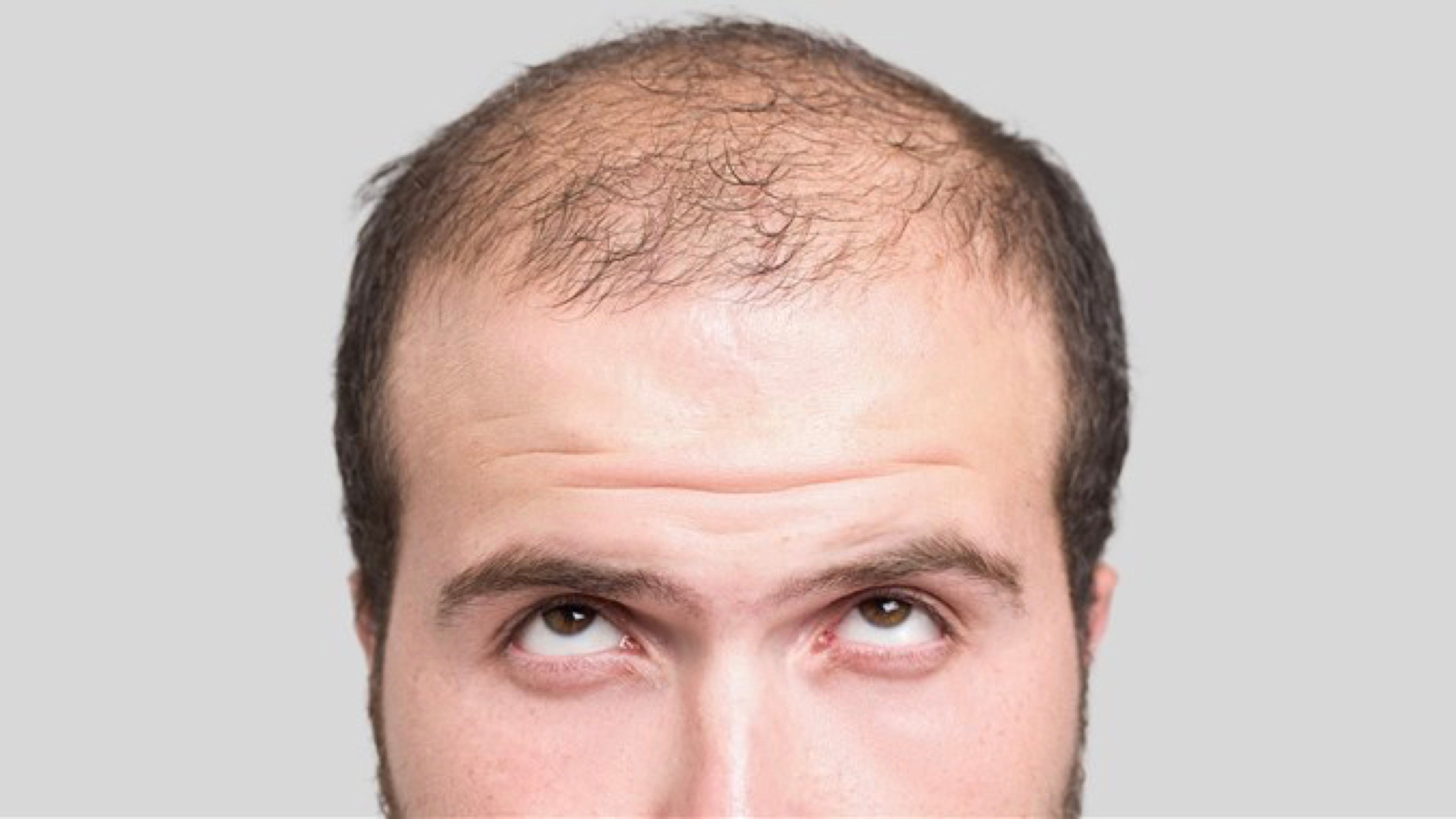 遗传性脱发最常发生于什么年龄段早了解早治疗