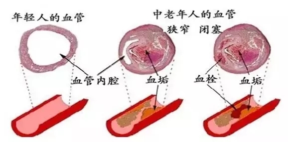 有人说,高血压放点血就会有好转了,是真的吗?__凤凰网