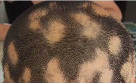如何鉴别斑秃和假性斑秃杭州植发医院