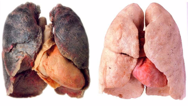 二手烟的肺部图片图片