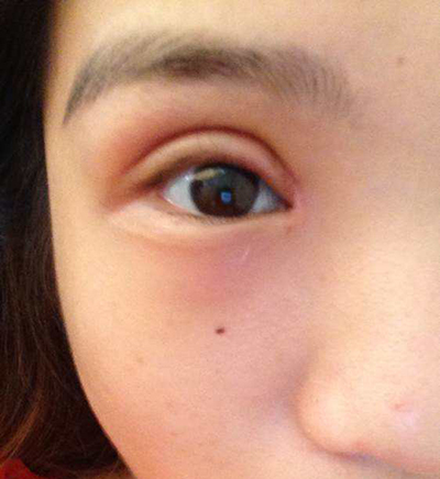 双眼皮术后"肉条眼"的成因及修复__凤凰网