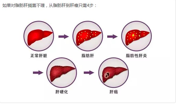 特殊人群运动指南之高血压,脂肪肝(你一定想不到,摆脱它们有多容易!