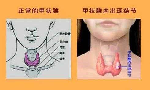 王克珍醫生:一起來了解甲狀腺疾病中的