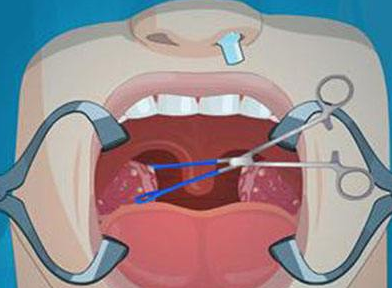 疾病的常见病之一,当扁平苔藓发生在舌头上时我们就称其为舌扁平苔藓