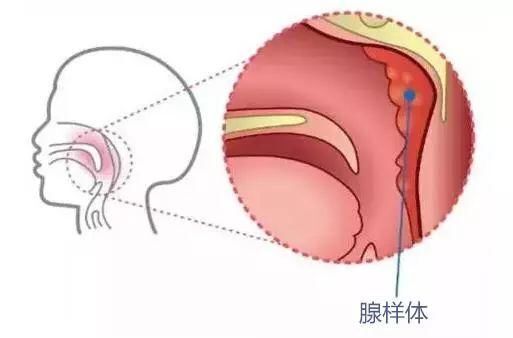 扁桃體的炎症波及而發生病理性增生,也就是我們常所說的