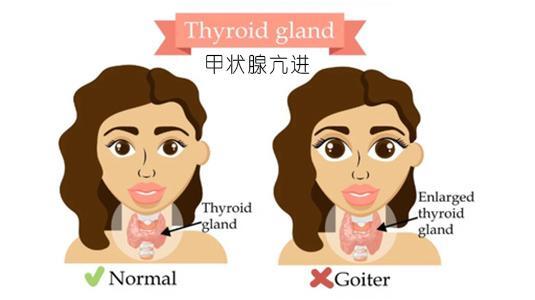 甲狀腺毒症是指由於甲狀腺本身或甲狀腺以外的多種原因引起的甲狀腺