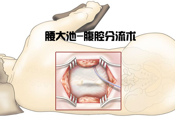 腰大池-腹腔分流術是治療腦積水常用的手術方法之一.