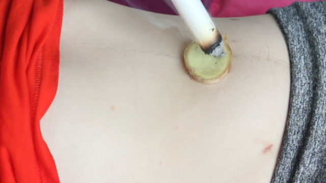 艾灸神阙穴治寒症且减肥