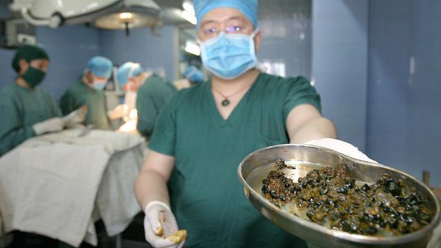 肾结石的帮凶抓到了4类食物多吃不忌口小心结石多又大