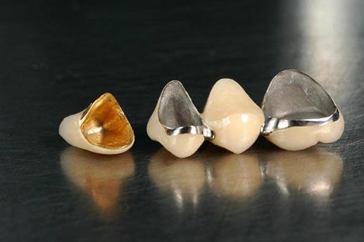 补牙后的牙套有几种?