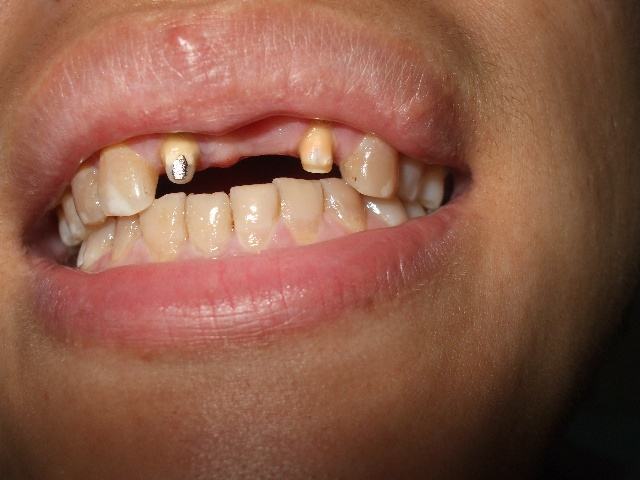 烤瓷牙崩瓷还能不能继续使用