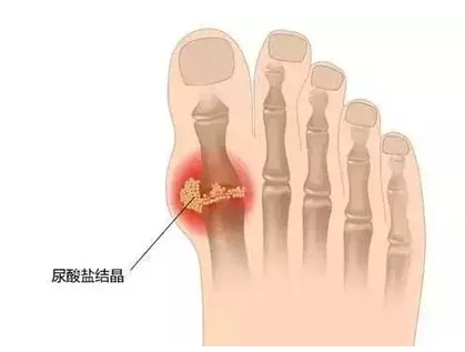 痛風石尿酸鹽結晶怎樣能夠溶解排出