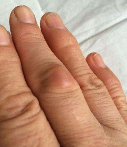 手指凸起吸烟者,身上若出现这2处"凸起"可能是肺撑不住了,请戒烟