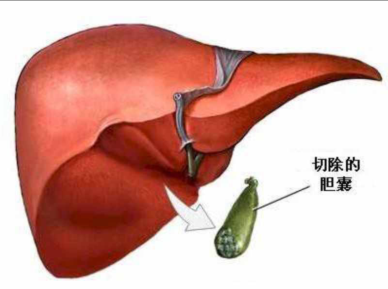 膽囊切除會否影響膽管結石發病率膽總管結石又叫肝外膽管結石,它分原