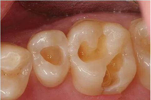補牙切記要趁早,小洞不補,大洞吃苦