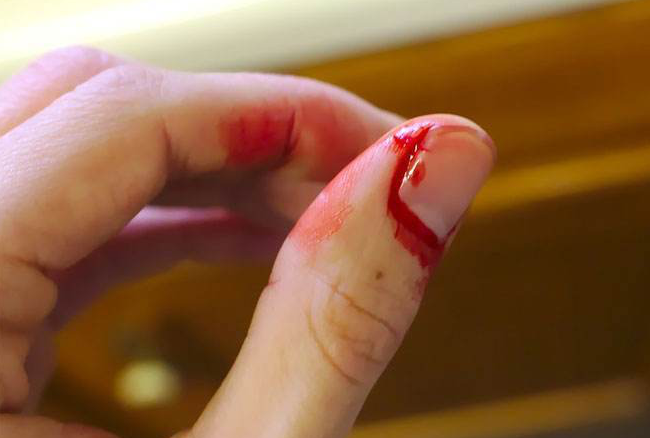 选择去角质但是注意,动作要轻柔,一定不要强行剥离皮屑,不要用小刀刮