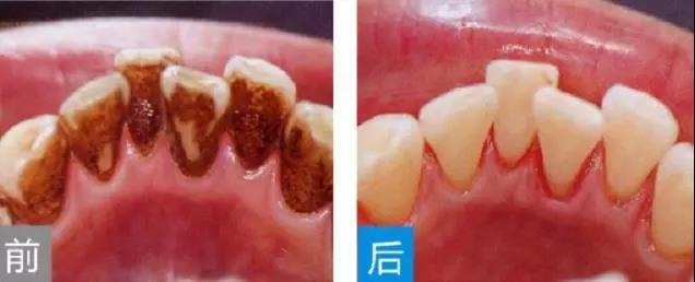 为什么有的黑斑连洗牙都去除不掉?