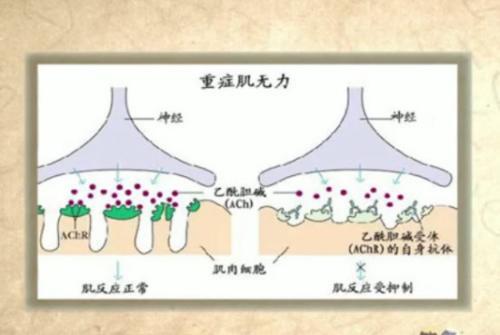 什么是重症肌无力,重症肌无力都有哪些症状?__凤凰网