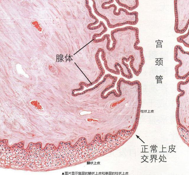 宫颈糜烂和宫颈癌之间有什么不可告知的秘密?