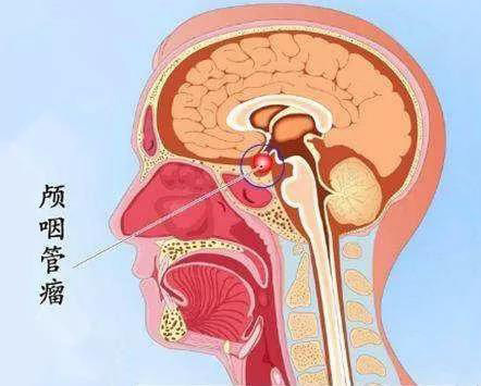 颅咽管瘤解剖位置图片