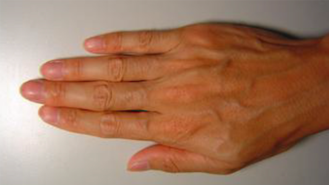 血脂高不高,看手就知道!当手上出现2个异常,说明你血脂升高了