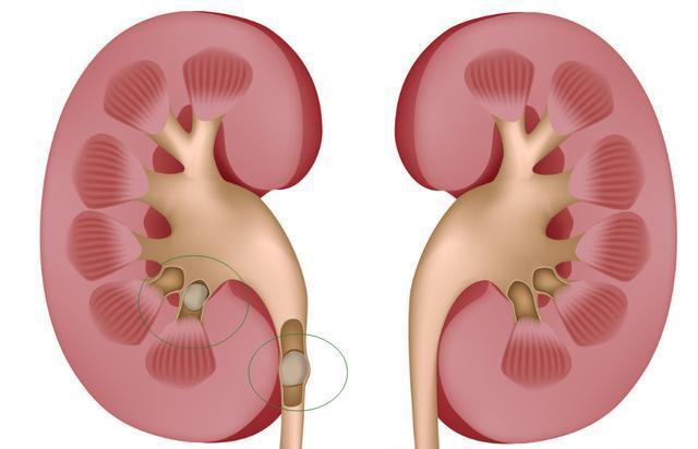 腎結石早期有哪些明顯的症狀產生因素結石專家詳細的告訴你