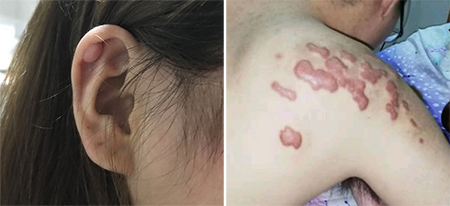 疤痕疙瘩的症状以及病因是什么