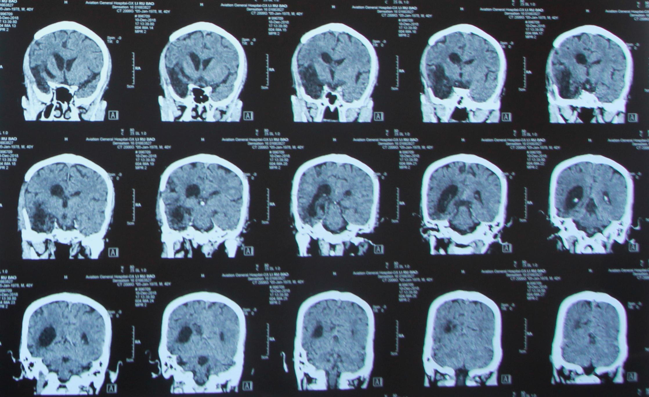 因為當時ct影像顯示,右側基底節區,靠近顳窩區大面積出血,腦幹受壓