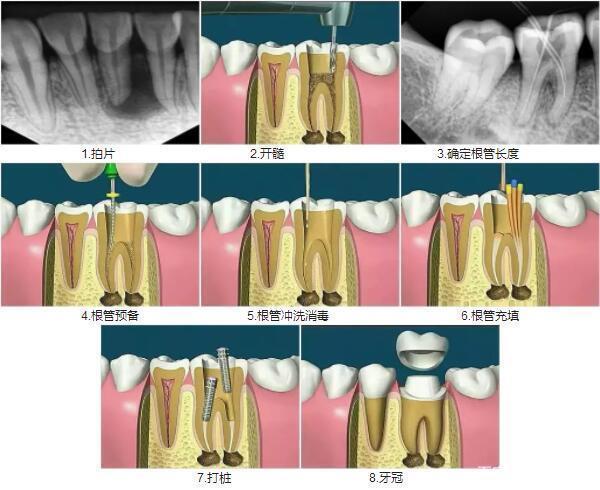 牙齿根管数量图解图片