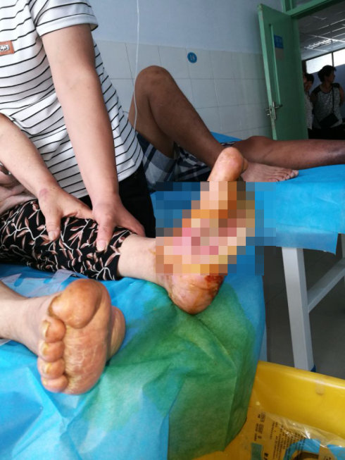 得了糖尿病之后 都会出现糖尿病足 烂脚 吗 凤凰网